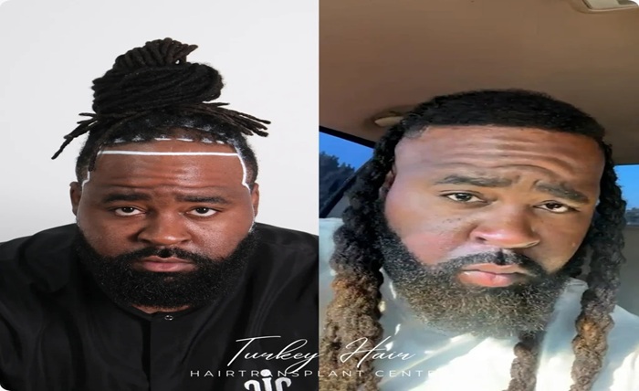 Hair Loss Awareness