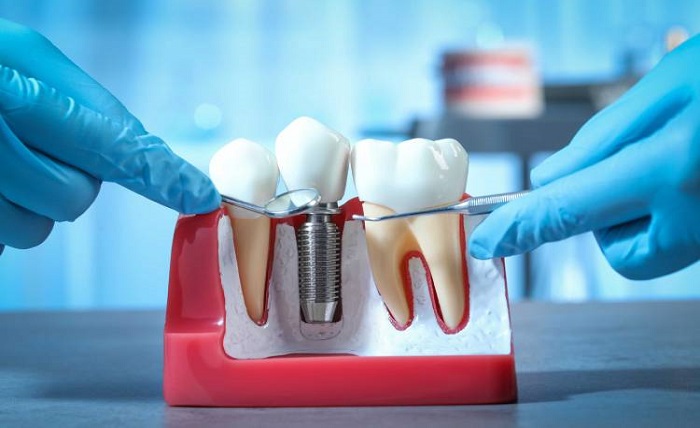 Dental Implants