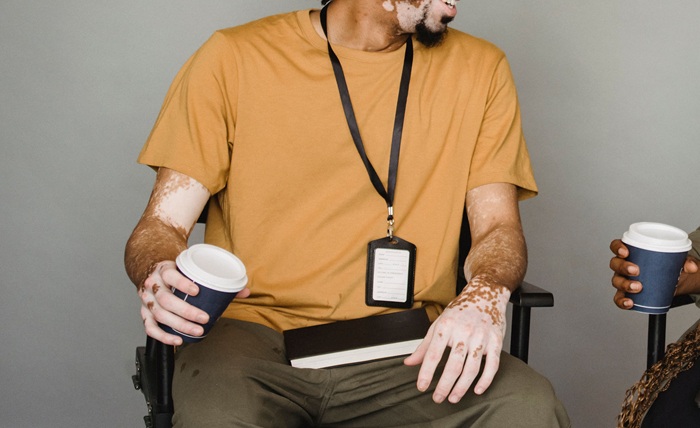 Vitiligo Treatment