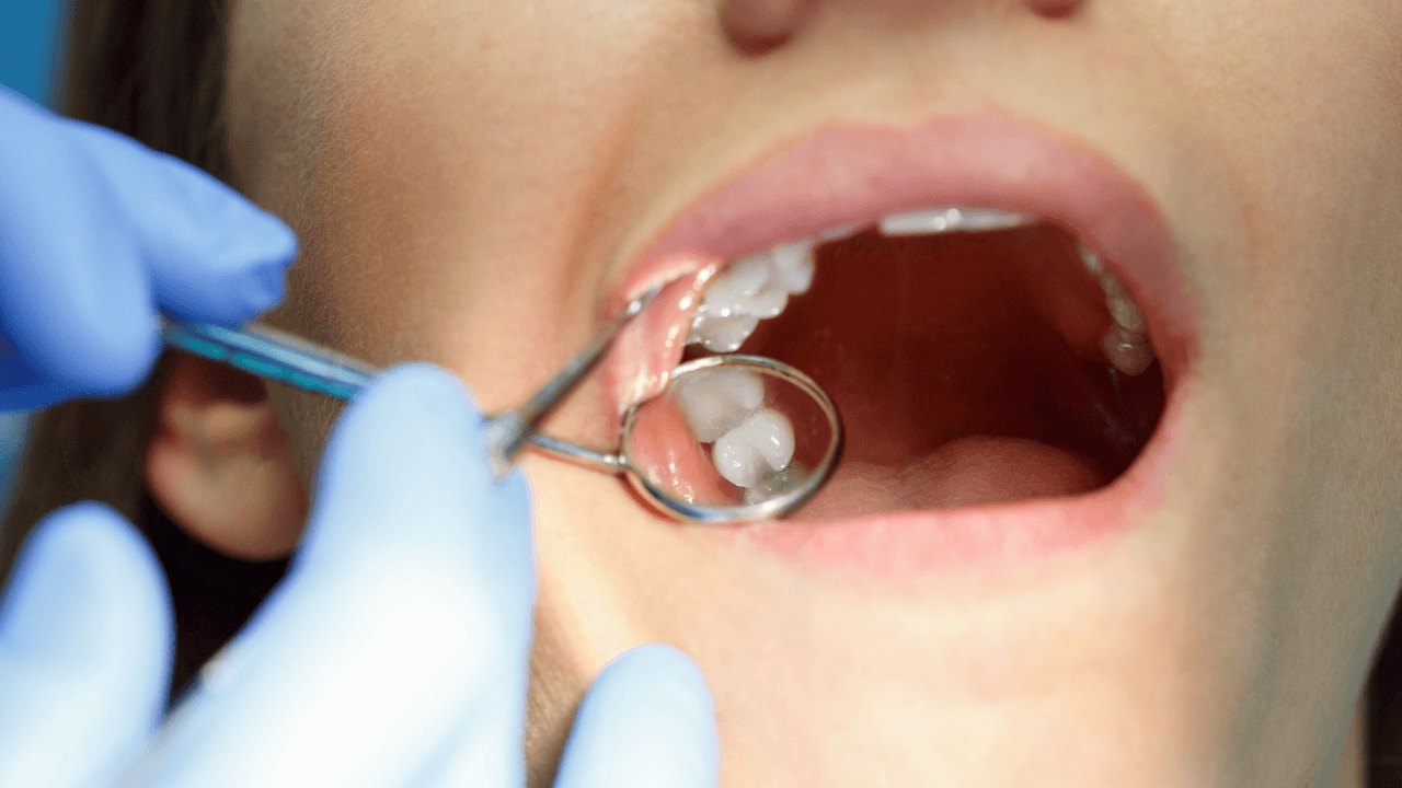 Who Should Get Dental Sealants?