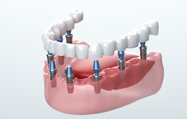 How Do Dental Implants Work?