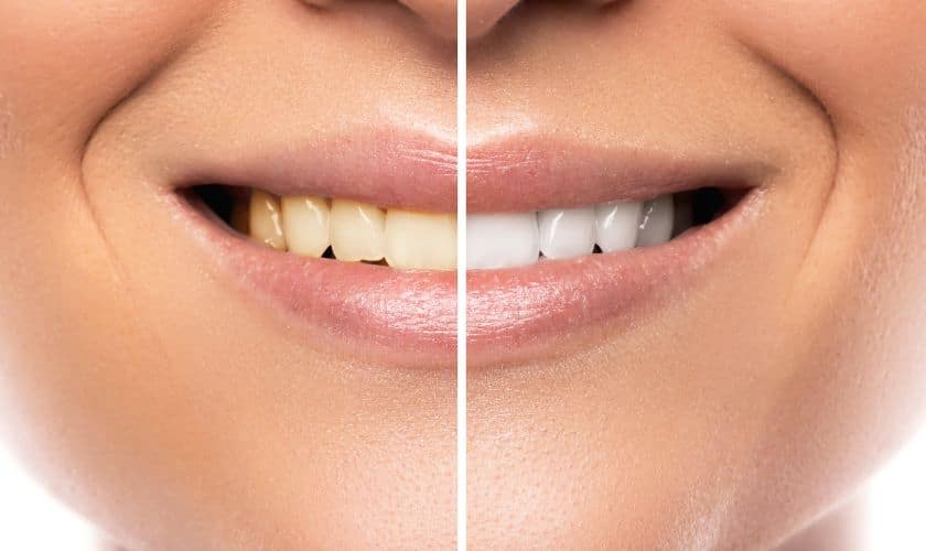 Achieving a Radiant Smile: Effective Teeth Whitening Techniques