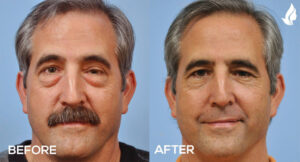 How Eyelid Surgery Can Enhance Your Natural Beauty