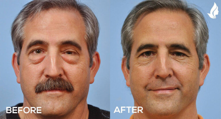 How Eyelid Surgery Can Enhance Your Natural Beauty