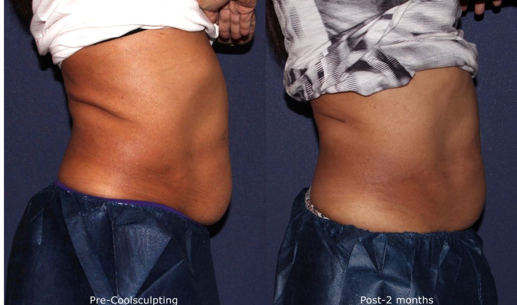 How Surgical Advancements Are Enhancing Body Contouring Results