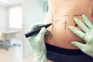 How to Decide if Liposuction is Right for You: Key Considerations
